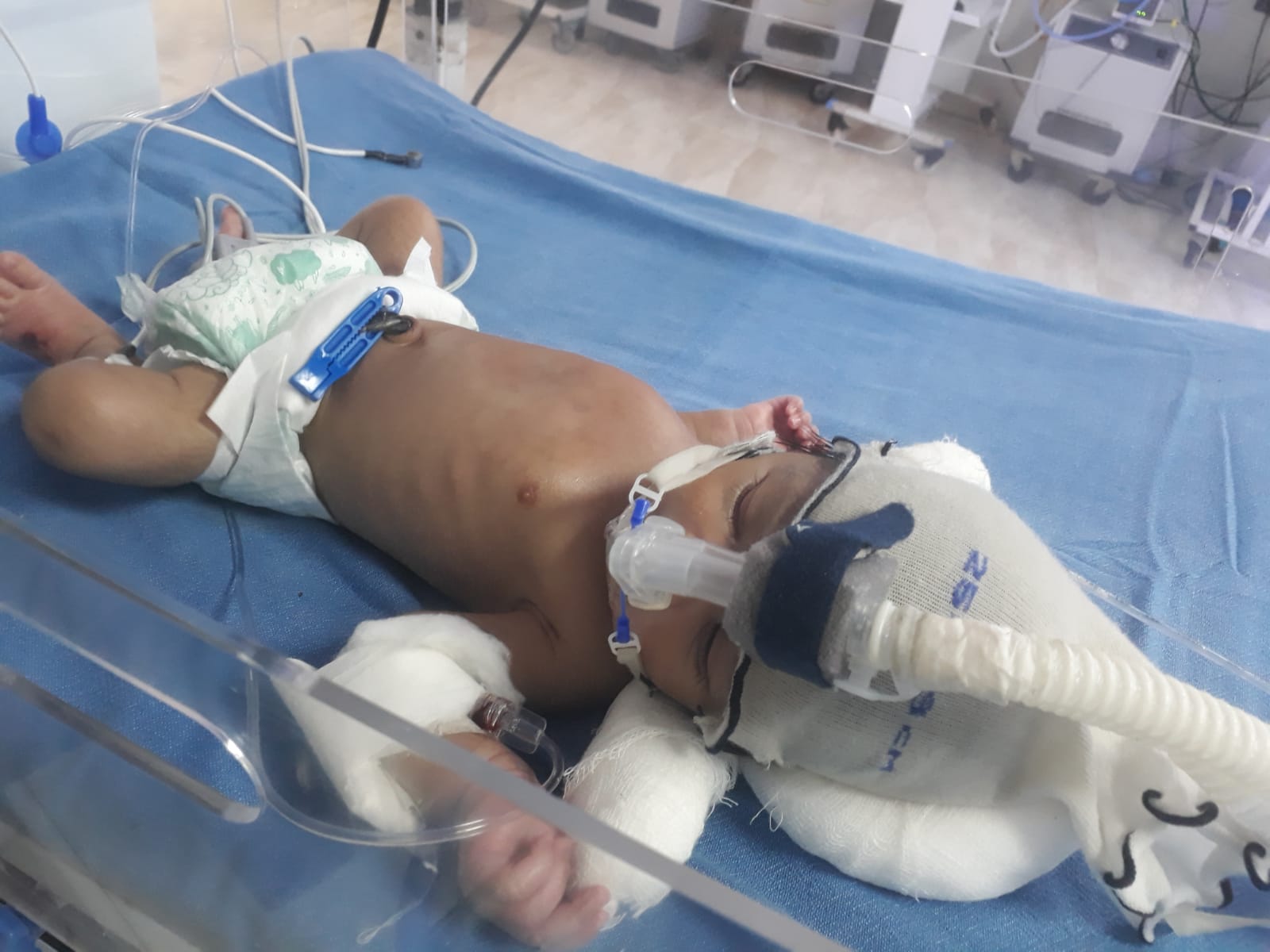 Help Save a 20-Day-Old Baby Girl Fighting for Her Life